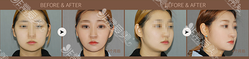 韩国拉菲安整形外科去颊脂垫手术案例对比图
