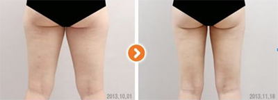 韩国365mc医院大腿吸脂手术对比案例