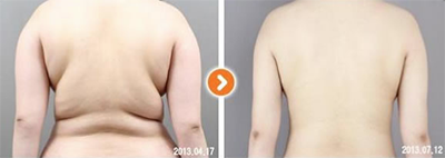 韩国365mc医院背部吸脂对比案例
