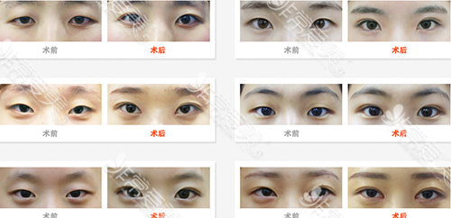 韩国4ever整形医院双眼皮日记对比效果图