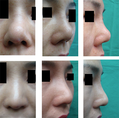 韩国saehan整形外科朝天鼻矫正手术对比案例