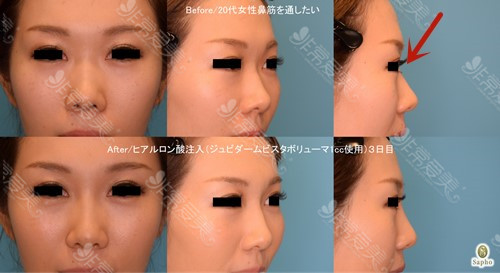 日本做鼻子好的医生案例图