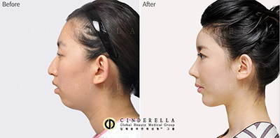 韩国新帝瑞娜整形外科鹰钩鼻矫正对比案例