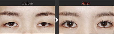 韩国原辰双眼皮整形对比