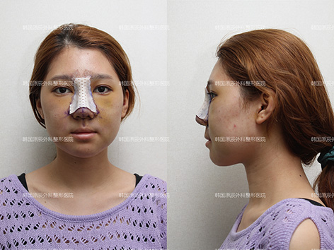 韩国原辰整形外科鼻综合对比手术