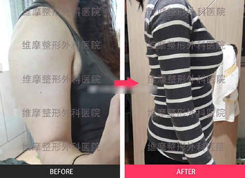 韩国维摩整形外科全身吸脂+脂肪填充优惠活动！！！