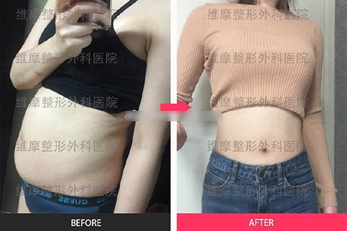 韩国维摩整形外科全身吸脂+脂肪填充优惠活动！！！