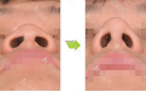 韩国缩鼻孔手术前后对比照片