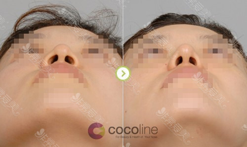 缩鼻孔手术前后对比照片