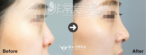 短鼻延长术对比照片