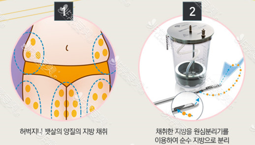 韩国Star21隆胸过程示意图