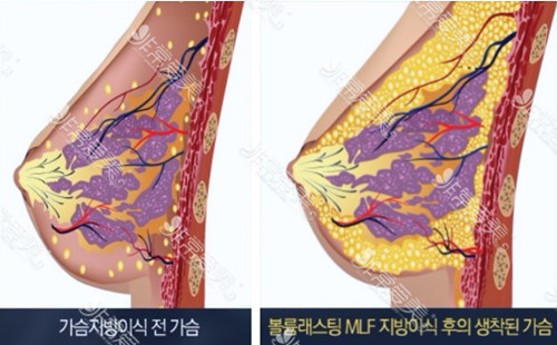 韩国Star21隆胸过程图示