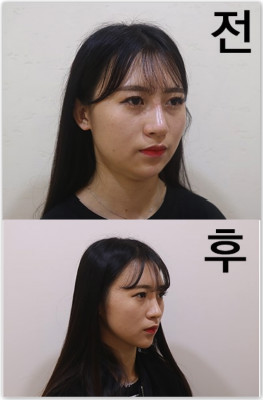 韩国下颌缘吸脂对比案例