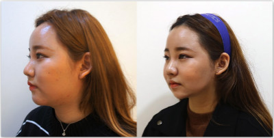 韩国raffine整形外科下颌缘吸脂对比