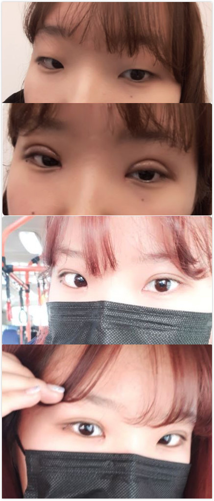 韩国小眼睛整形对比