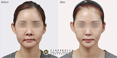 面部埋线提升手术对比案例