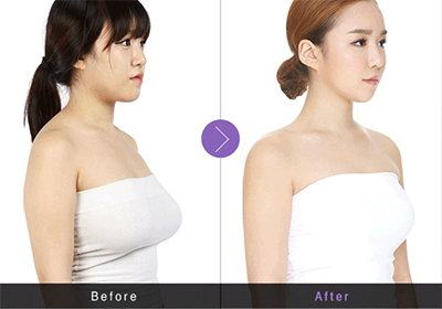 乳房提升术效果图图片
