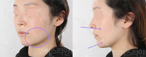 脸型轮廓术后下垂图片