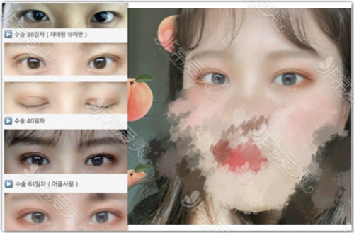 韩国蜡笔整形医院眼部手术对比