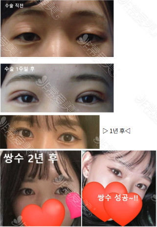 韩国美丽的人整形外科眼综合