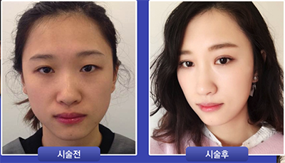 韩国111整形外科眼鼻综合案例对比效果