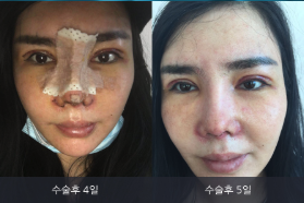 韩国鼻挛缩修复手术