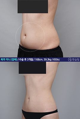 韩国安瑟琳整形外科腰腹环吸效果