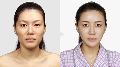 韩国TL整形外科下颌角手术对比案例
