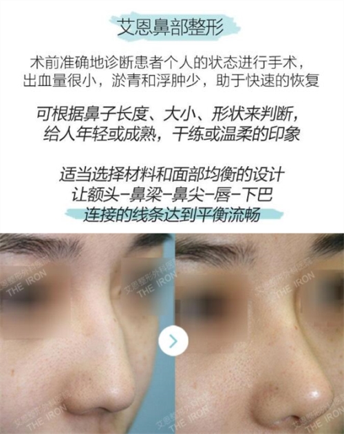 韩国艾恩鼻部整形优势介绍图