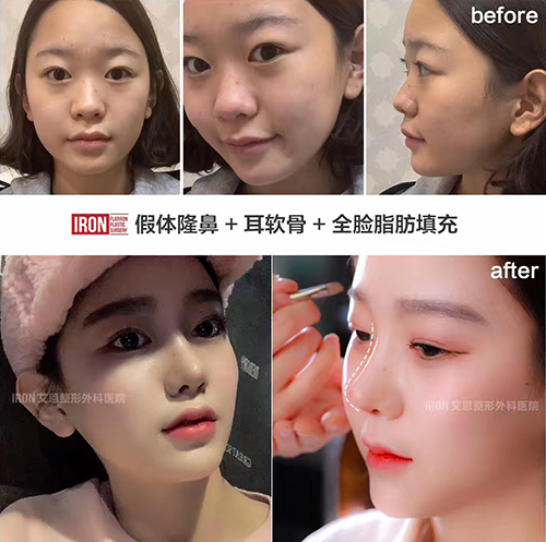 韩国艾恩隆鼻+面部填充案例图