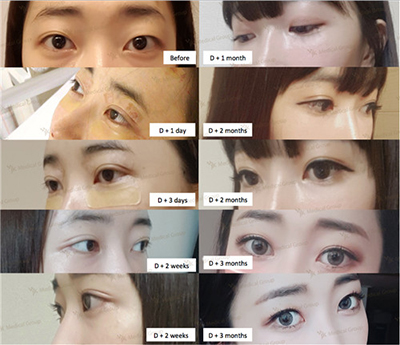韩国JK整形外科双眼皮手术对比案例