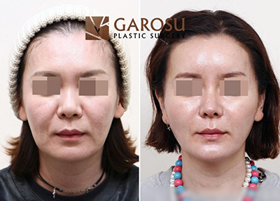 韩国凯伦秀整形外科面部提升前后对比照片