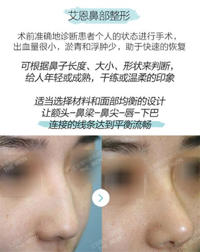韩国艾恩整形外科隆鼻优势图