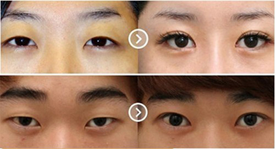 眼睑下垂矫正手术对比案例