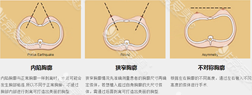 韩国麦恩和丽珍哪家隆胸效果好？真人案例对比明显吗？