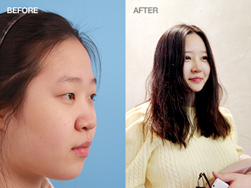 韩国大邱oblige整形外科面部提升前后照片