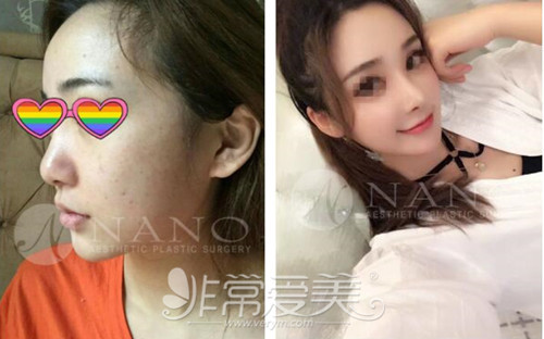 韩国Nano、trend、Cocoline隆鼻医院哪个好?隆鼻案例对比图有吗?