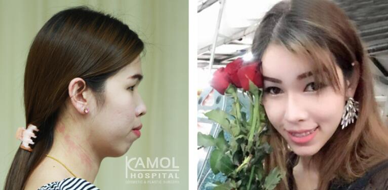 泰国KAMOL咖蒙美容面部综合整形前后照片