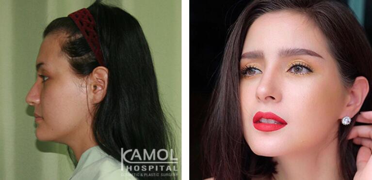 泰国KAMOL咖蒙整形医院隆鼻前后对比照片