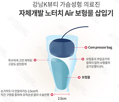韩国气压植入隆胸假体示意图