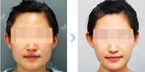 韩国江南K-beauty整形外科面部轮廓