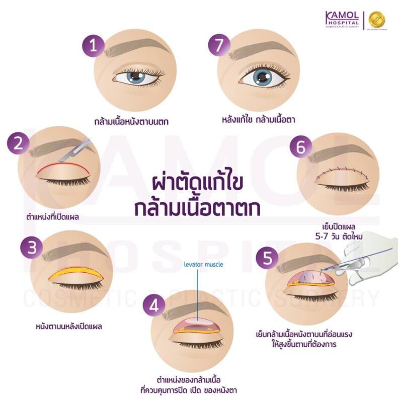 泰国咖蒙整形医院双眼皮整形过程图