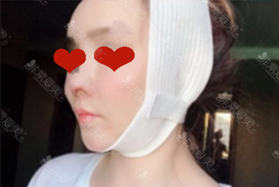 碧夏整形外科隆鼻恢复过程图