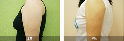 韩国4ever整形外科手臂吸脂手术对比案例