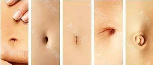 肚脐眼整形案例图片曝光,韩国GIO医院肚脐整形效果看得见！