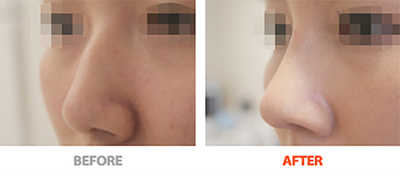 假体隆鼻手术对比案例