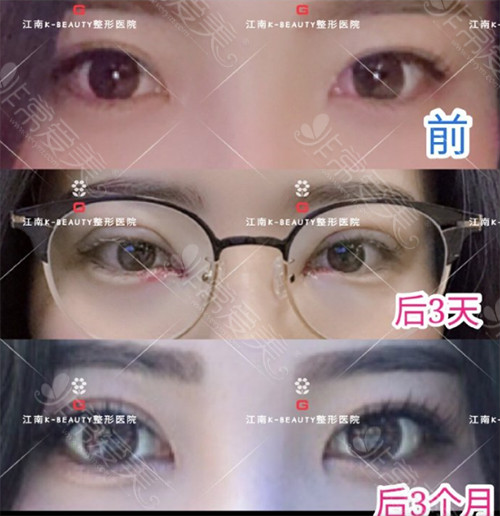 江南k-beauty整形外科眼见矫正手术对比案例