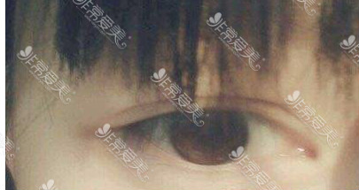 双眼皮眼部提肌手术危害分析，韩国k-beauty要用非切开避免！