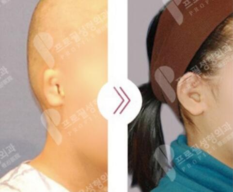 韩国profile普罗菲耳医院小耳畸形矫正照片