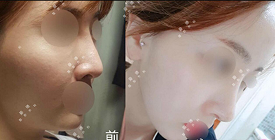 韩国MIND曼德整形外科隆鼻前后对比照片